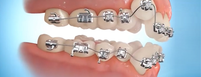 Orthodontic Treatment - Imperial Dental Specialist Centre