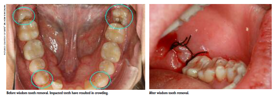 treating-wisdom-teeth-imperial-dental-specialist-centre